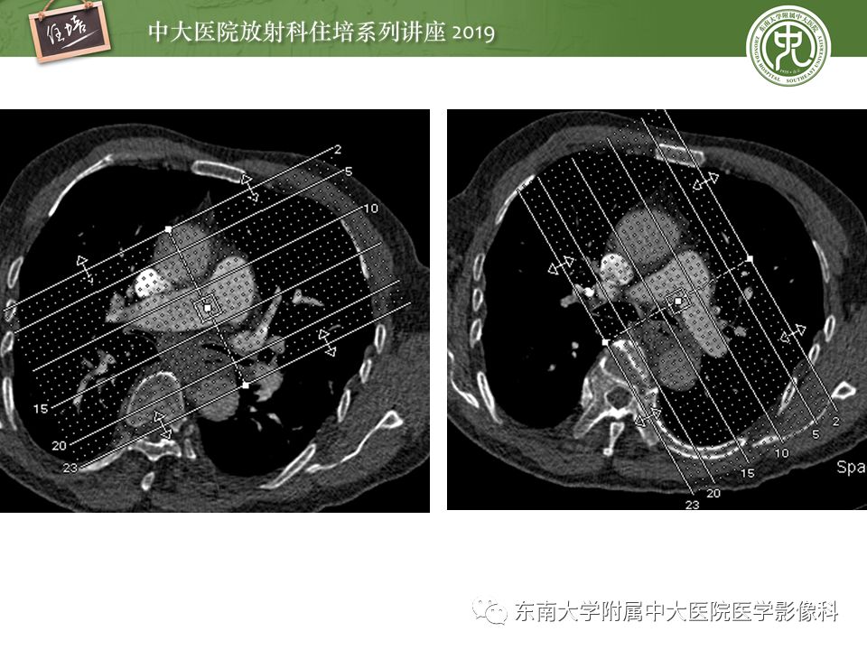【PPT】肺动脉栓塞扫描流程、三维重建及影像评估