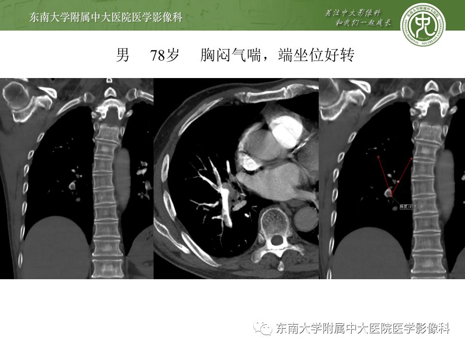 【PPT】肺动脉栓塞扫描流程、三维重建及影像评估