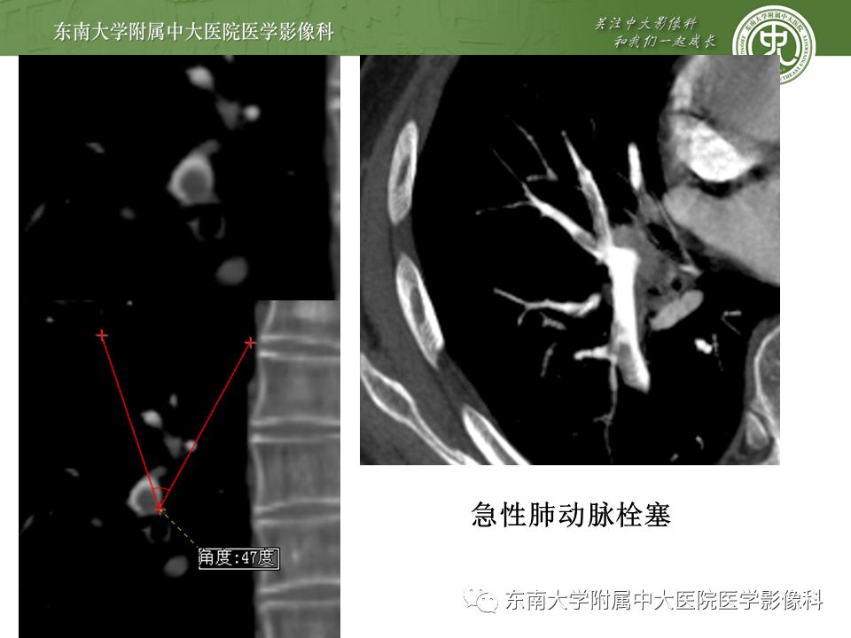 【PPT】肺动脉栓塞扫描流程、三维重建及影像评估