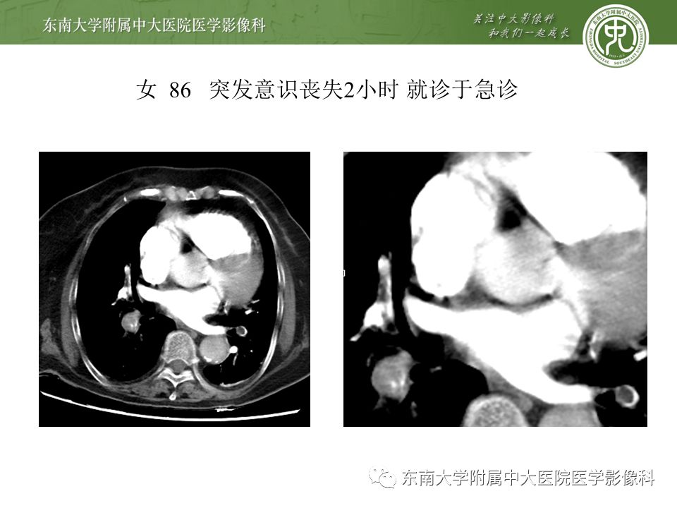 【PPT】肺动脉栓塞扫描流程、三维重建及影像评估