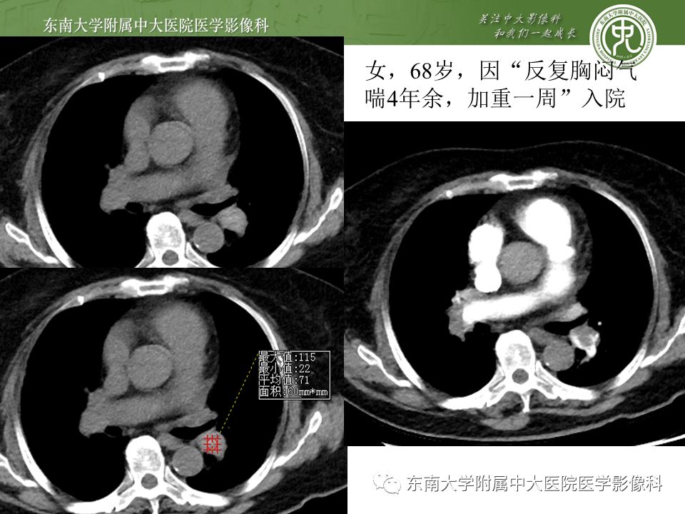 【PPT】肺动脉栓塞扫描流程、三维重建及影像评估