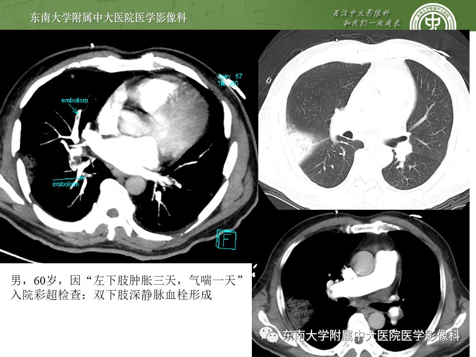 【PPT】肺动脉栓塞扫描流程、三维重建及影像评估