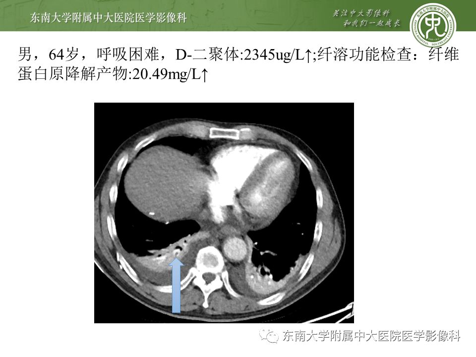 【PPT】肺动脉栓塞扫描流程、三维重建及影像评估