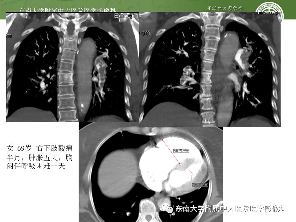 【PPT】肺动脉栓塞扫描流程、三维重建及影像评估