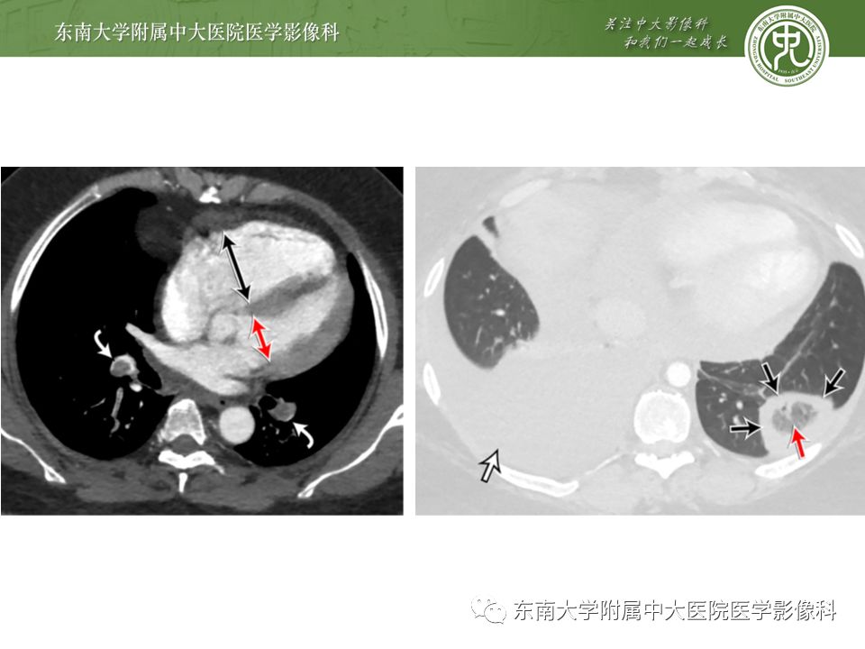 【PPT】肺动脉栓塞扫描流程、三维重建及影像评估
