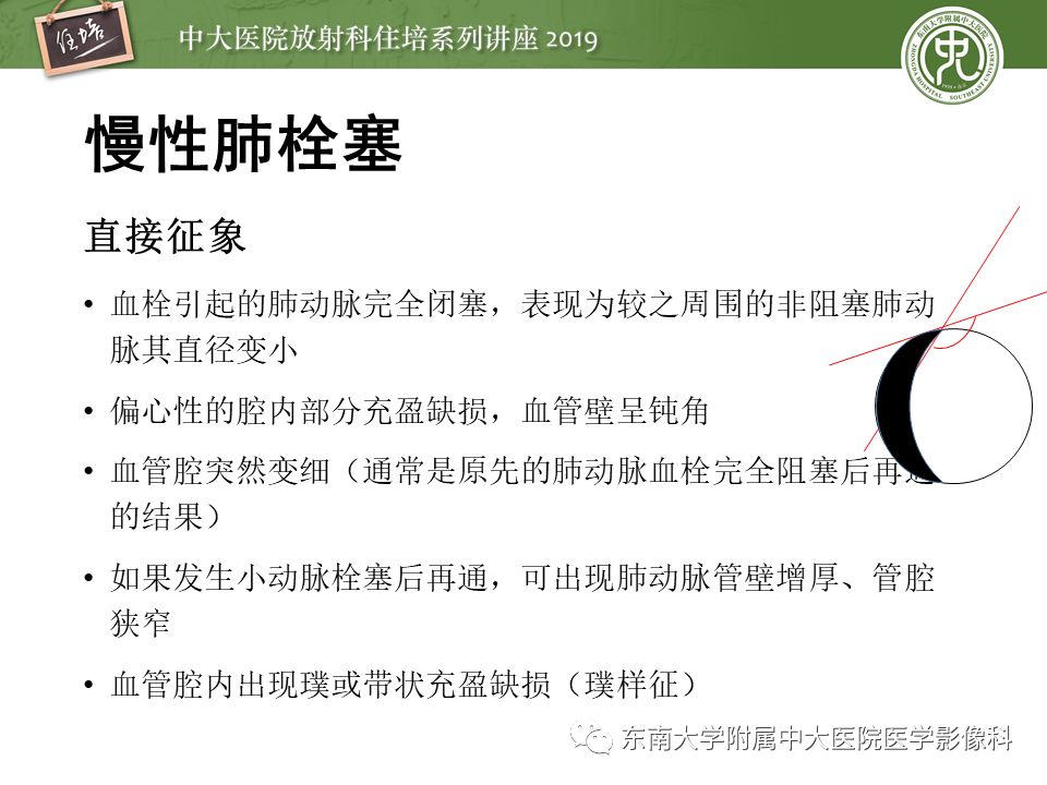 【PPT】肺动脉栓塞扫描流程、三维重建及影像评估