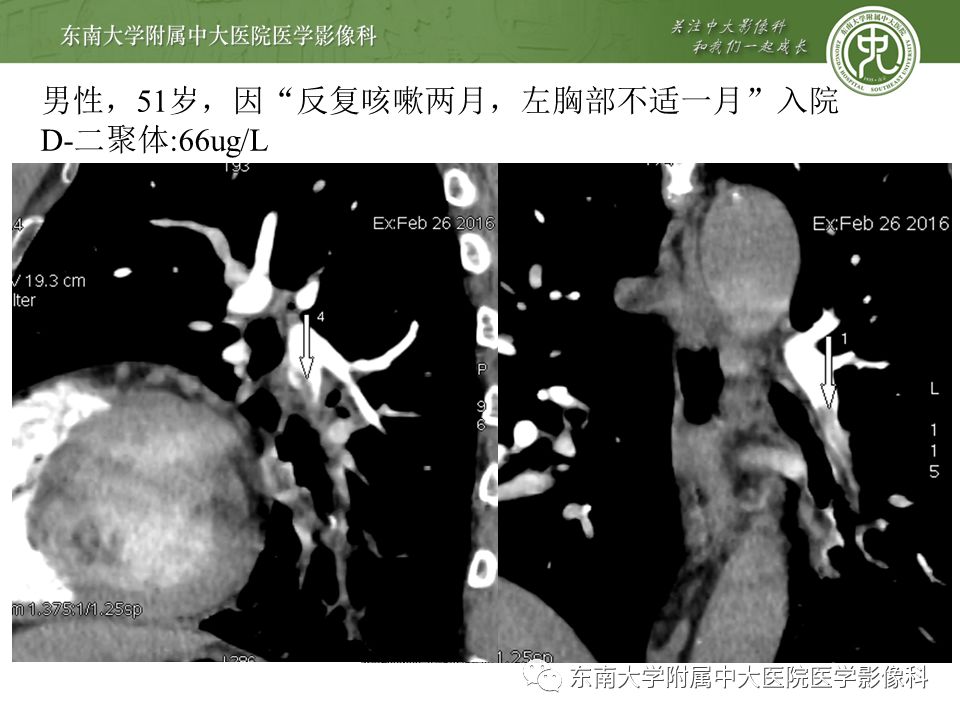 【PPT】肺动脉栓塞扫描流程、三维重建及影像评估