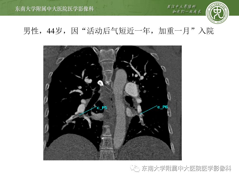 【PPT】肺动脉栓塞扫描流程、三维重建及影像评估