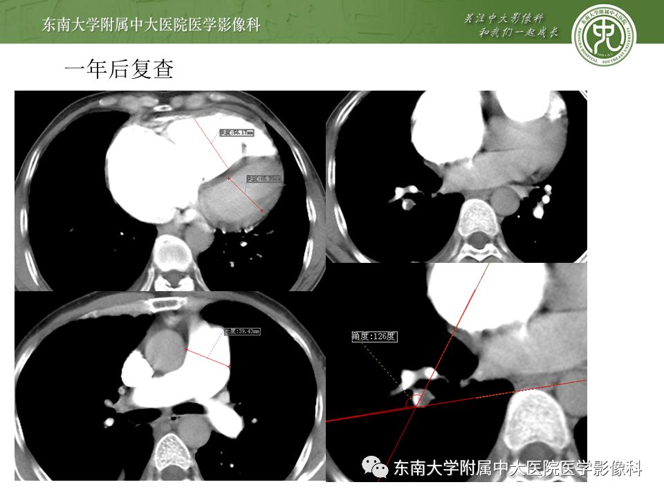 【PPT】肺动脉栓塞扫描流程、三维重建及影像评估