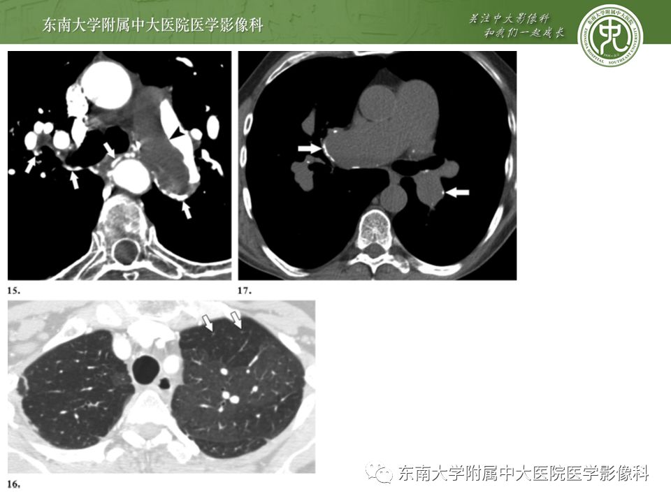 【PPT】肺动脉栓塞扫描流程、三维重建及影像评估
