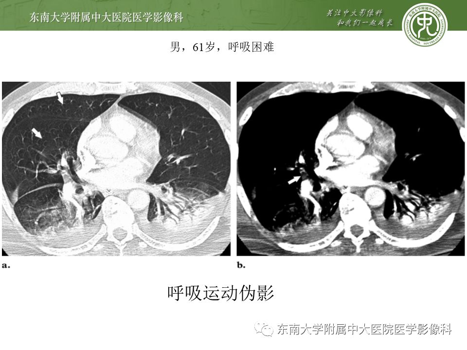 【PPT】肺动脉栓塞扫描流程、三维重建及影像评估