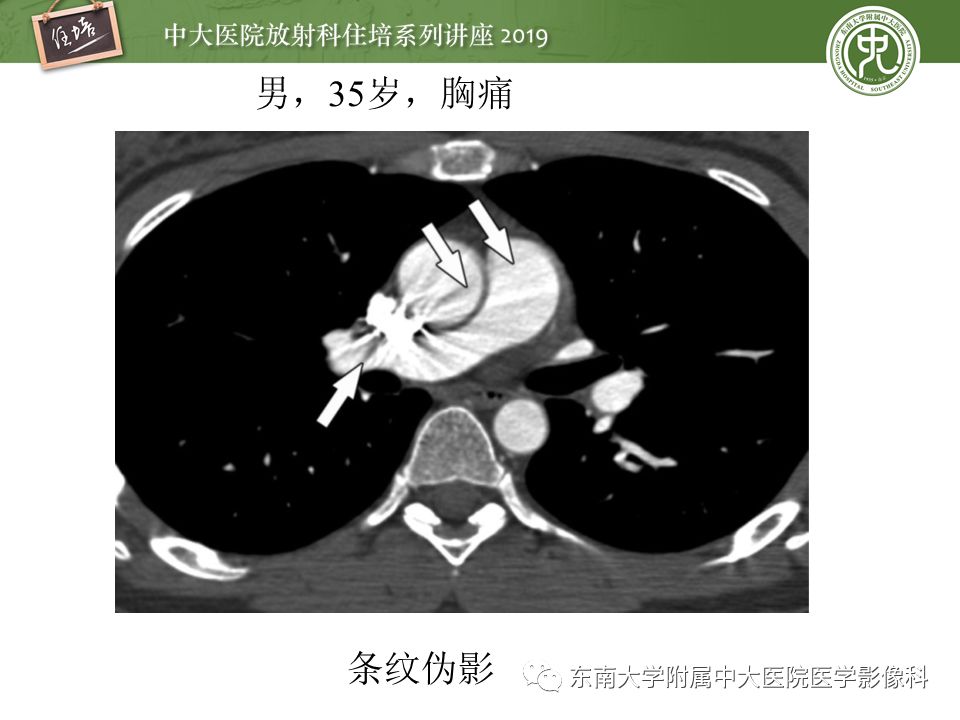 【PPT】肺动脉栓塞扫描流程、三维重建及影像评估