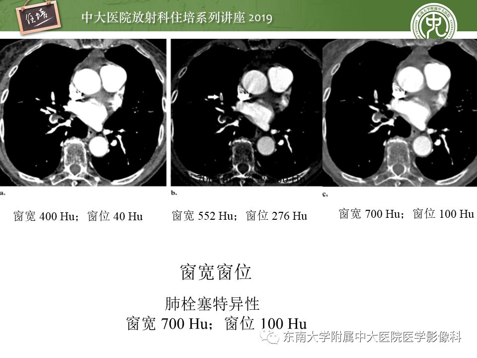 【PPT】肺动脉栓塞扫描流程、三维重建及影像评估