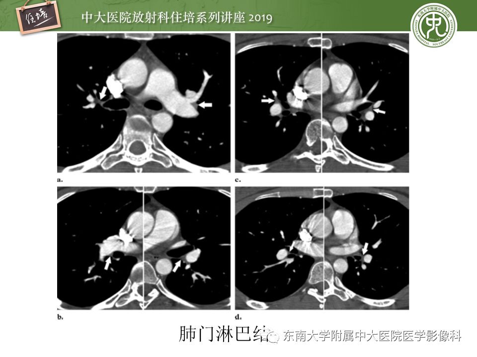 【PPT】肺动脉栓塞扫描流程、三维重建及影像评估