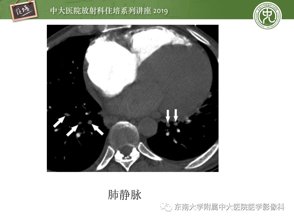 【PPT】肺动脉栓塞扫描流程、三维重建及影像评估