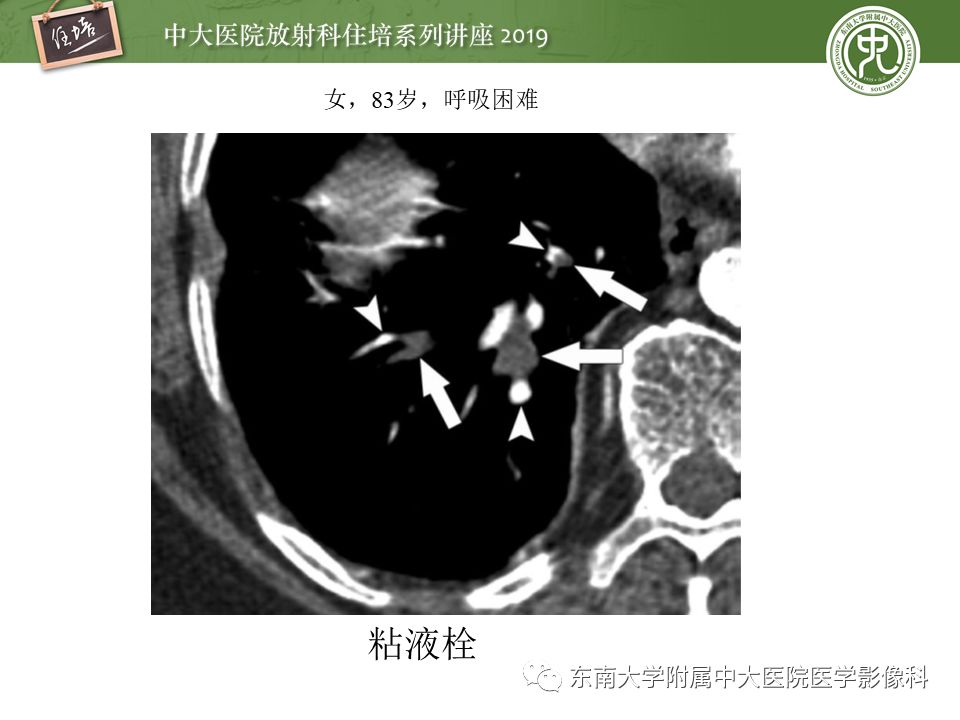 【PPT】肺动脉栓塞扫描流程、三维重建及影像评估