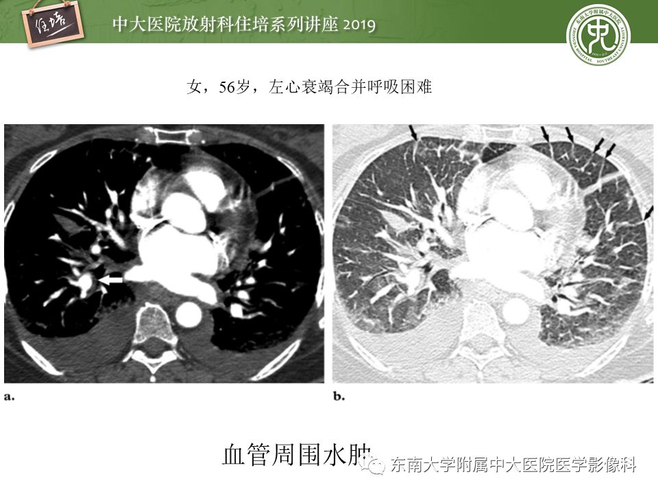 【PPT】肺动脉栓塞扫描流程、三维重建及影像评估