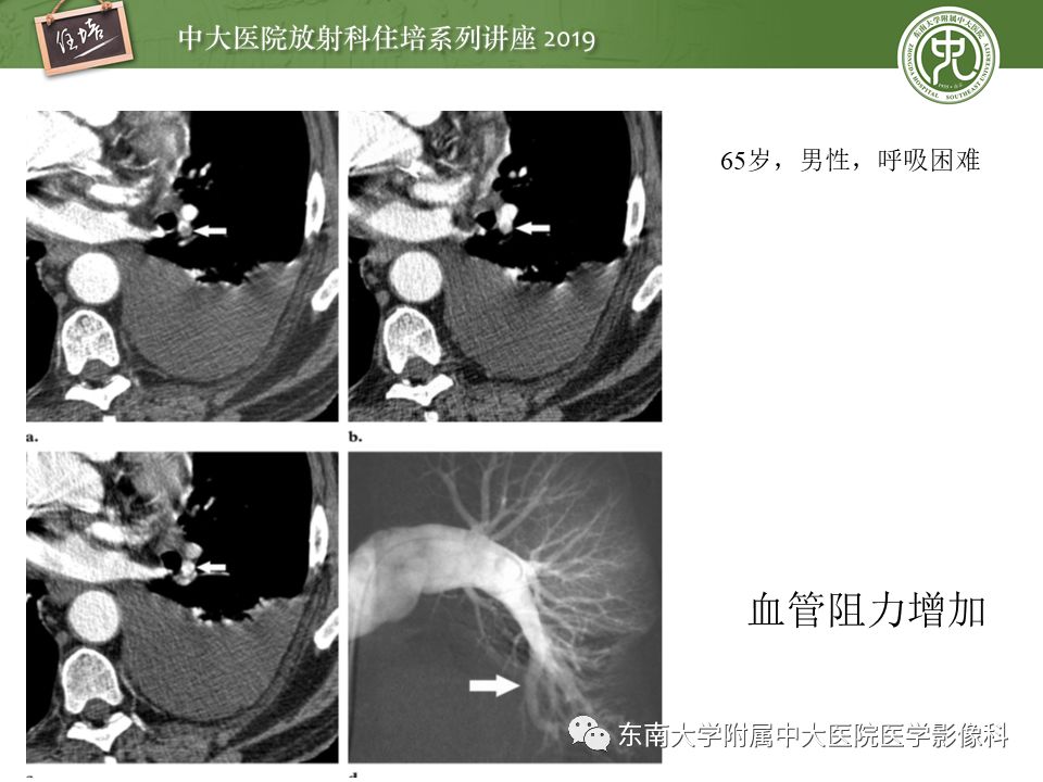 【PPT】肺动脉栓塞扫描流程、三维重建及影像评估