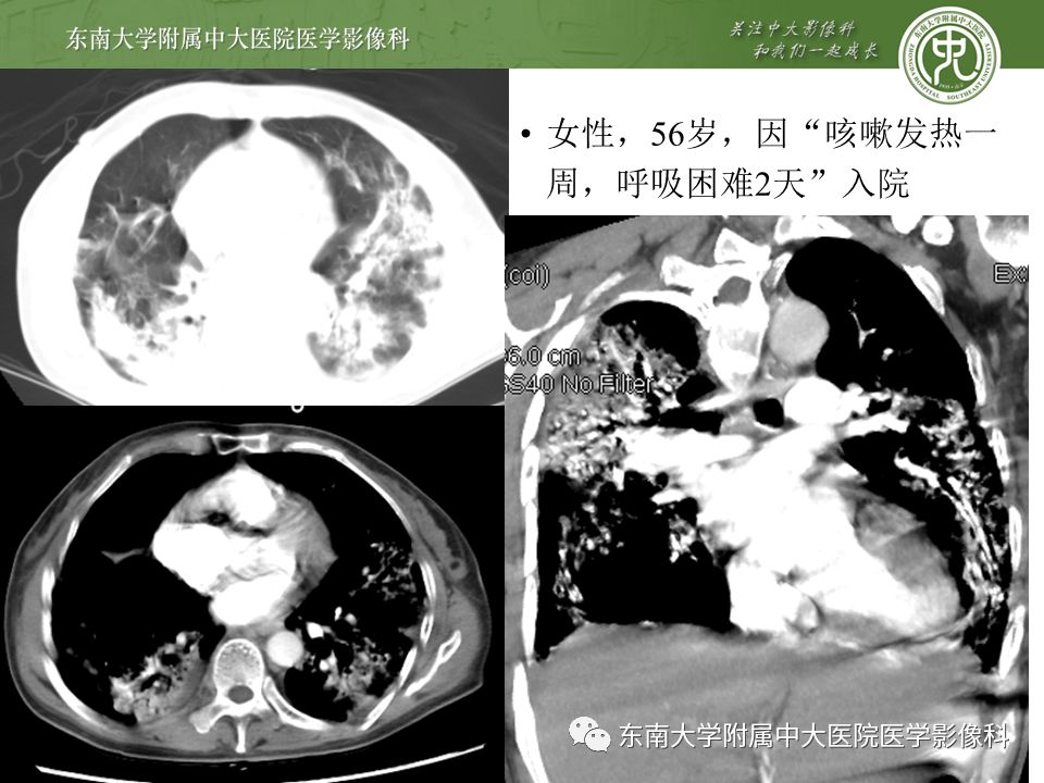 【PPT】肺动脉栓塞扫描流程、三维重建及影像评估