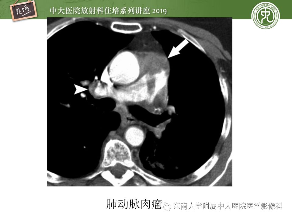【PPT】肺动脉栓塞扫描流程、三维重建及影像评估