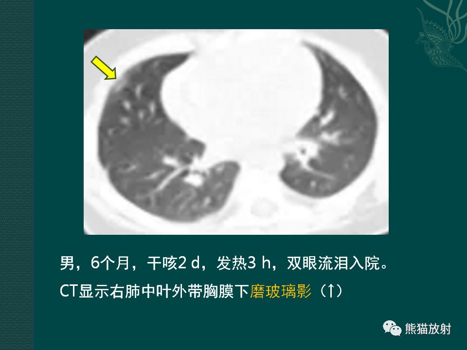 【PPT】儿童新型冠状病毒肺炎（NCP）高分辨率CT表现
