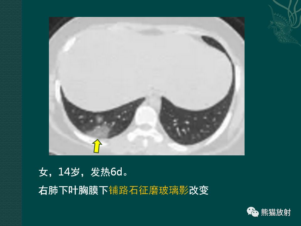 【PPT】儿童新型冠状病毒肺炎（NCP）高分辨率CT表现