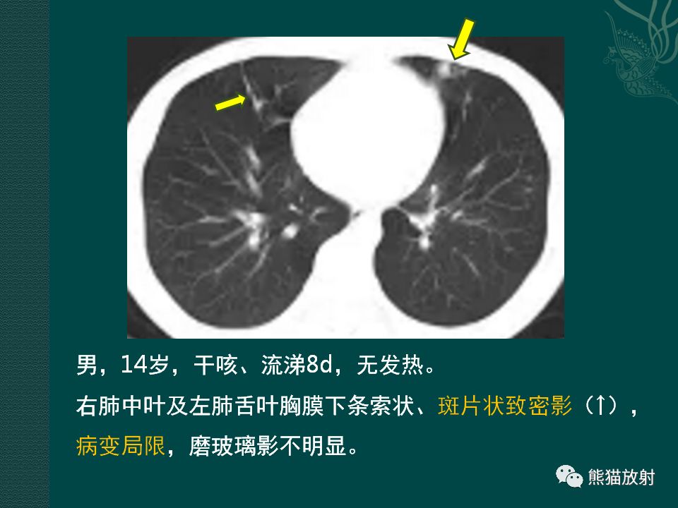 【PPT】儿童新型冠状病毒肺炎（NCP）高分辨率CT表现