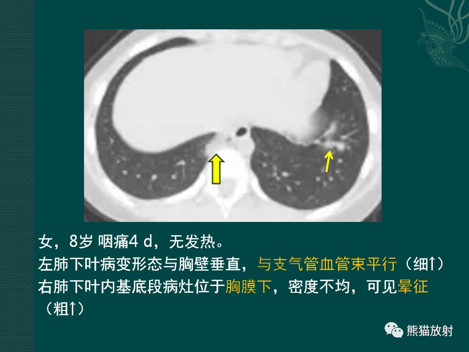 【PPT】儿童新型冠状病毒肺炎（NCP）高分辨率CT表现