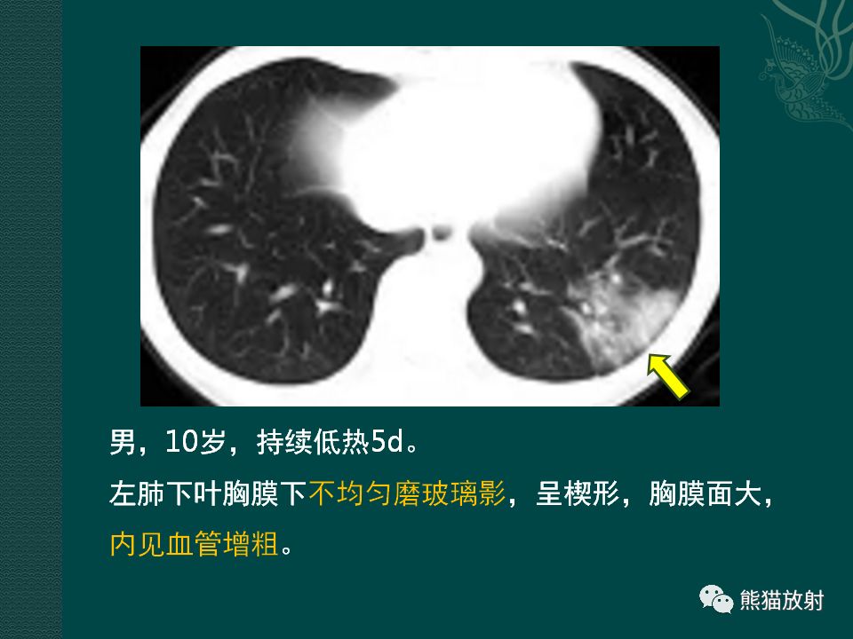 【PPT】儿童新型冠状病毒肺炎（NCP）高分辨率CT表现