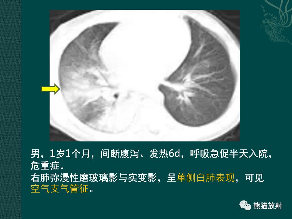【PPT】儿童新型冠状病毒肺炎（NCP）高分辨率CT表现