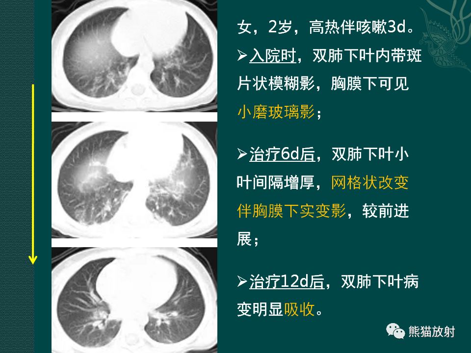 【PPT】儿童新型冠状病毒肺炎（NCP）高分辨率CT表现