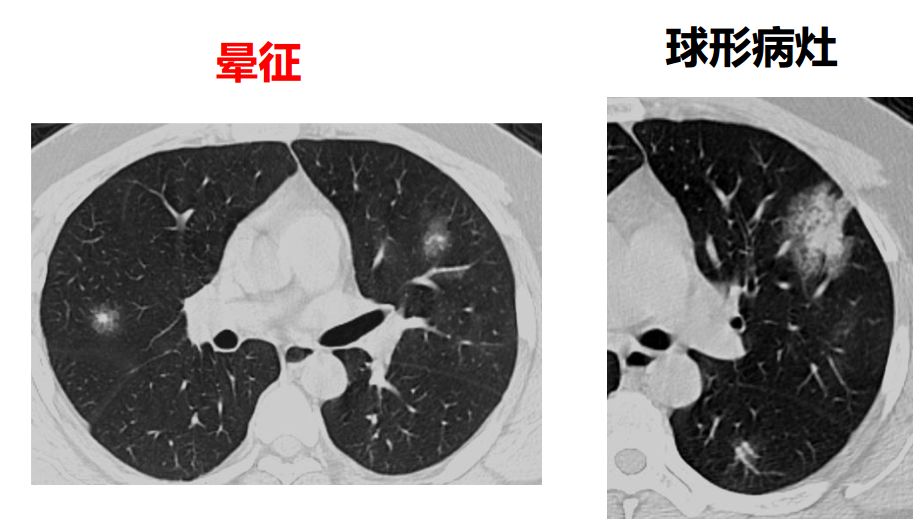 这 5 个病例都是新型冠状病毒肺炎么?征象解读等着你 这 5 个病例都是新型冠状病毒肺炎么?征象解读等着你