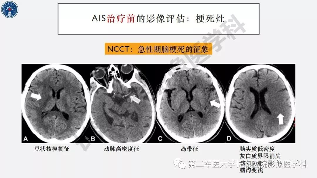 【PPT】2019中国《急性缺血性脑血管病影像指导规范》解读