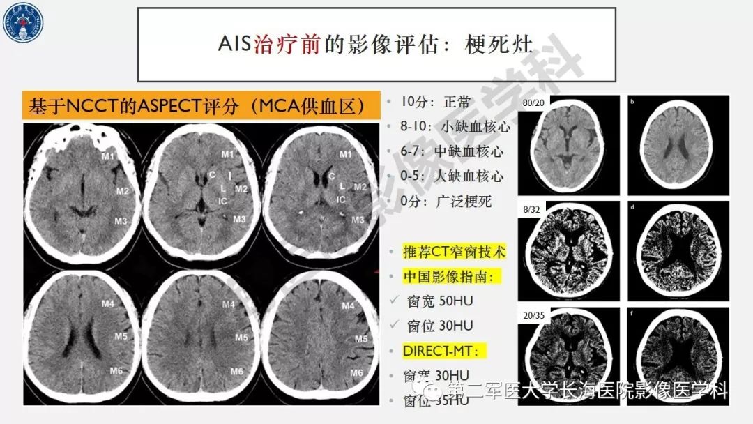 【PPT】2019中国《急性缺血性脑血管病影像指导规范》解读