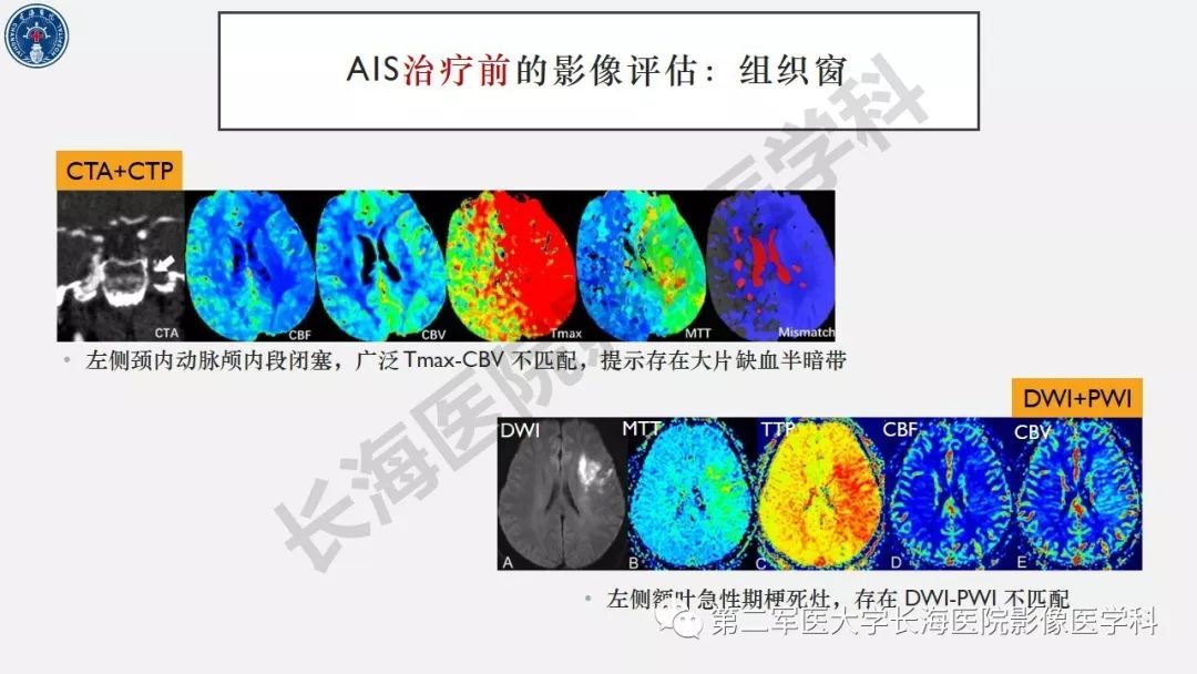 【PPT】2019中国《急性缺血性脑血管病影像指导规范》解读