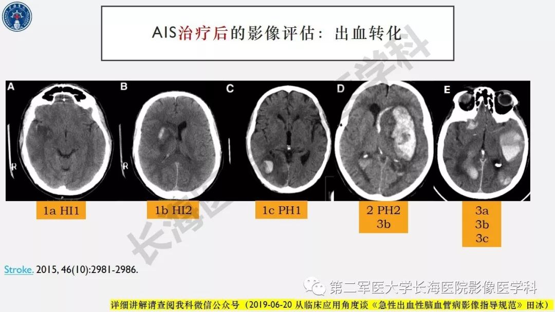 【PPT】2019中国《急性缺血性脑血管病影像指导规范》解读