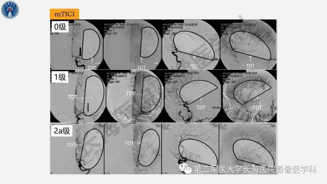 【PPT】2019中国《急性缺血性脑血管病影像指导规范》解读