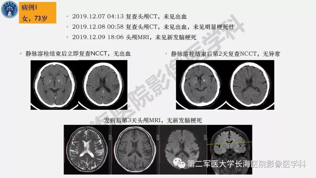 【PPT】2019中国《急性缺血性脑血管病影像指导规范》解读