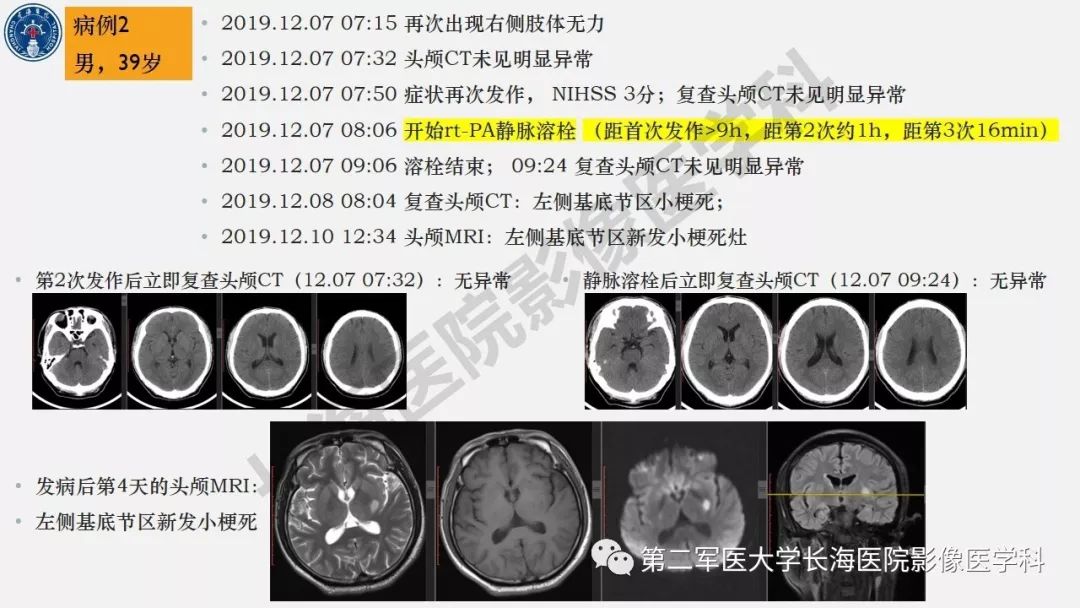 【PPT】2019中国《急性缺血性脑血管病影像指导规范》解读