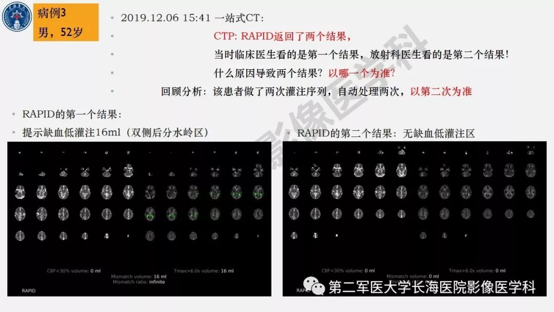 【PPT】2019中国《急性缺血性脑血管病影像指导规范》解读