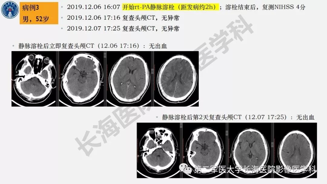 【PPT】2019中国《急性缺血性脑血管病影像指导规范》解读