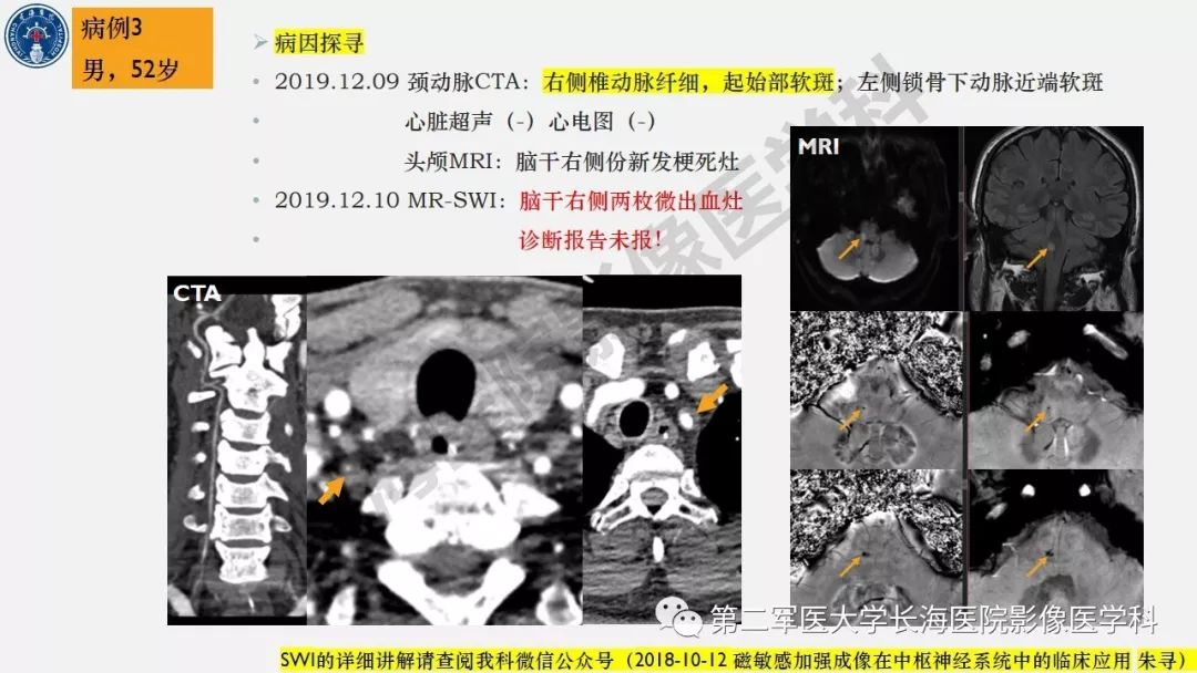 【PPT】2019中国《急性缺血性脑血管病影像指导规范》解读