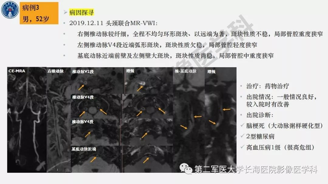 【PPT】2019中国《急性缺血性脑血管病影像指导规范》解读