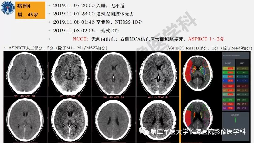 【PPT】2019中国《急性缺血性脑血管病影像指导规范》解读