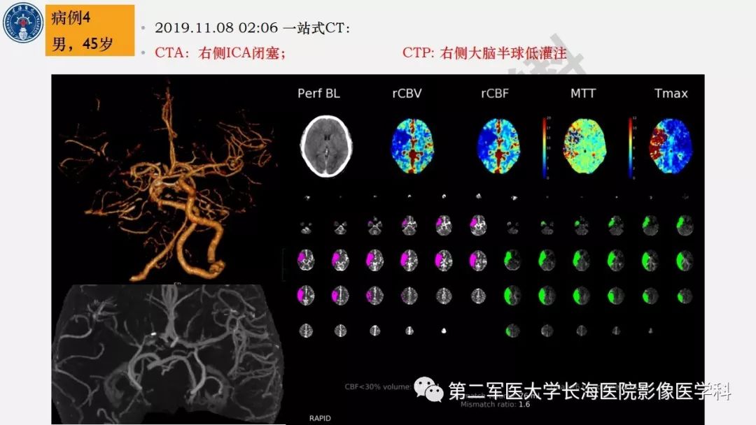 【PPT】2019中国《急性缺血性脑血管病影像指导规范》解读