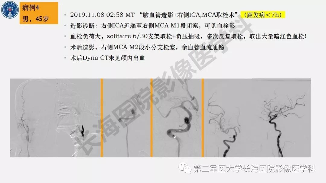 【PPT】2019中国《急性缺血性脑血管病影像指导规范》解读