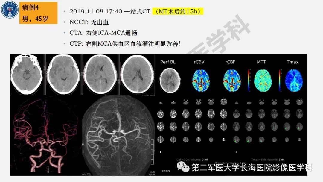 【PPT】2019中国《急性缺血性脑血管病影像指导规范》解读