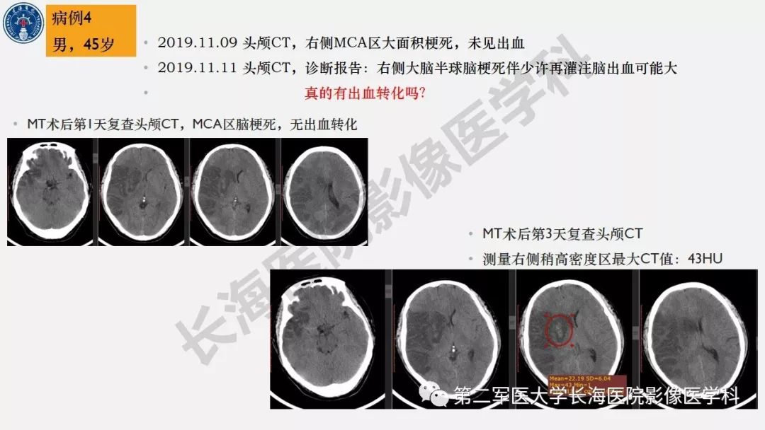 【PPT】2019中国《急性缺血性脑血管病影像指导规范》解读