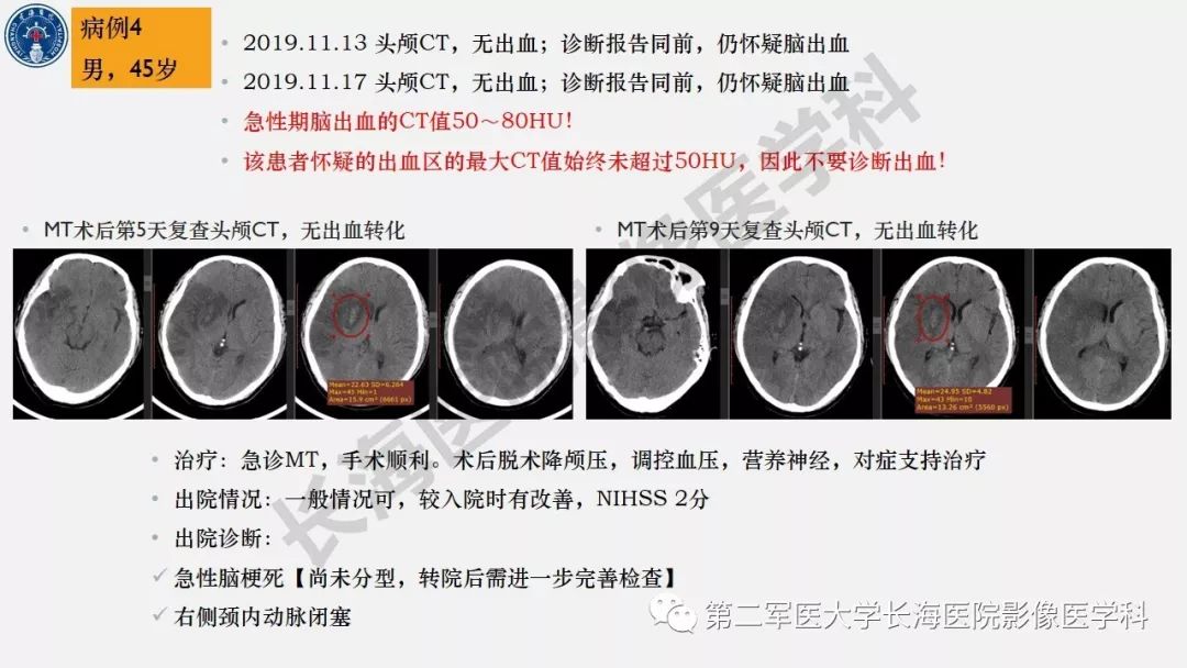 【PPT】2019中国《急性缺血性脑血管病影像指导规范》解读