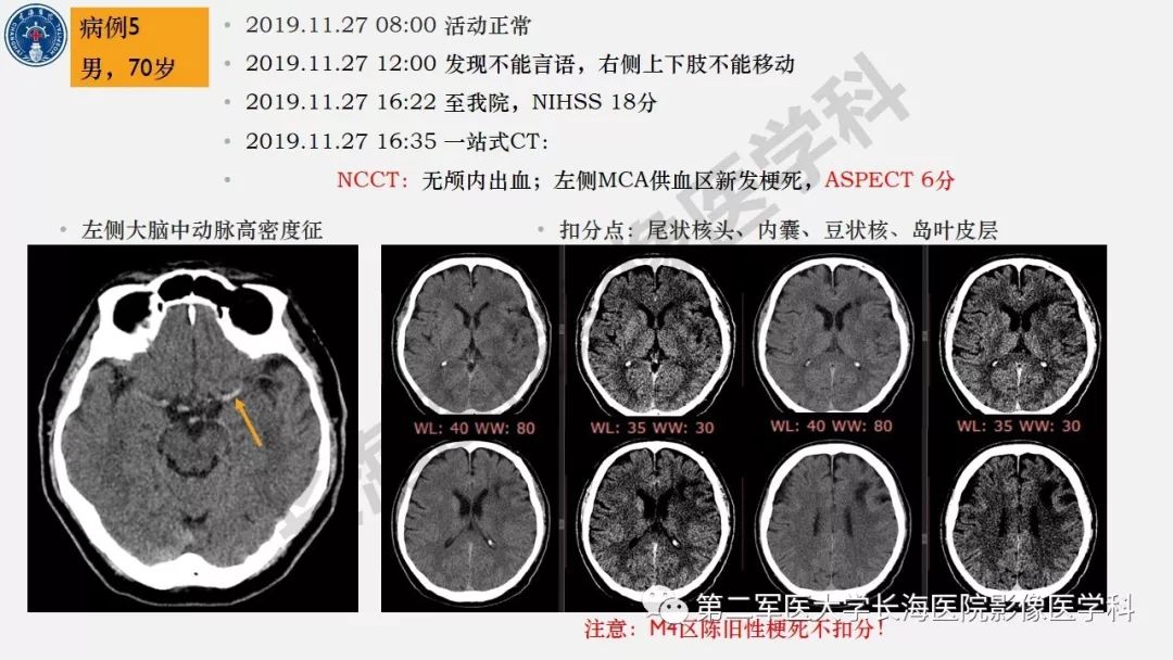 【PPT】2019中国《急性缺血性脑血管病影像指导规范》解读